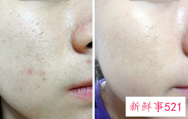 激光治疗毛孔粗大需要多少次美容