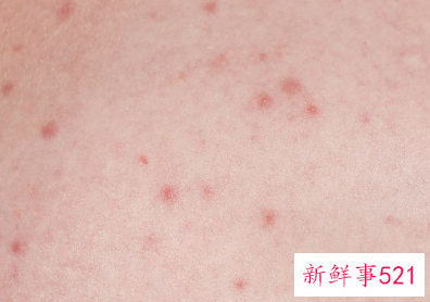 婴儿湿疹怎么根治