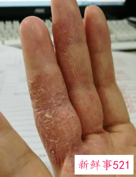 手干燥粗糙裂口怎么办