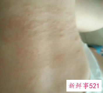 婴儿湿疹怎么根治