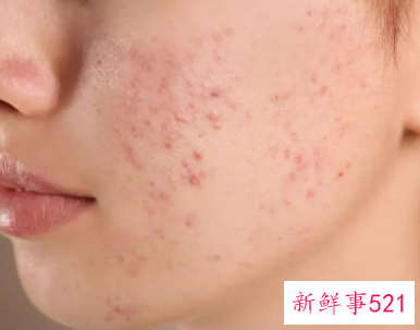 雀斑如何淡化雀斑小窍门