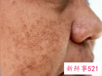 色素沉着会自愈吗