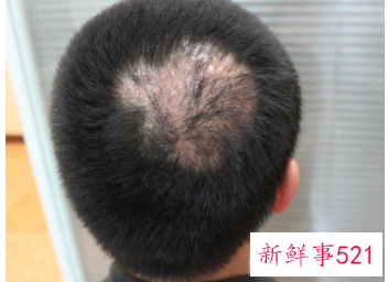 头部有疤不长头发