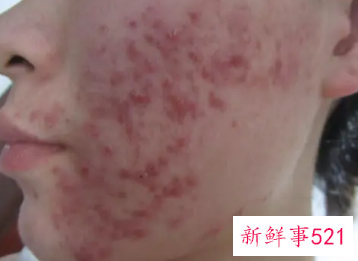 男生青春痘怎么才能消除