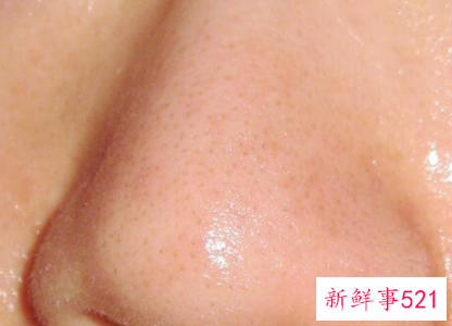 毛孔挤出黄颗粒