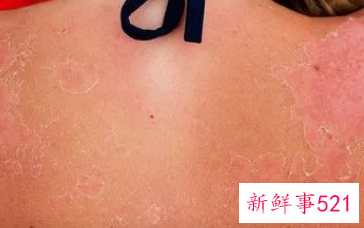 孩子脸上皮肤晒伤