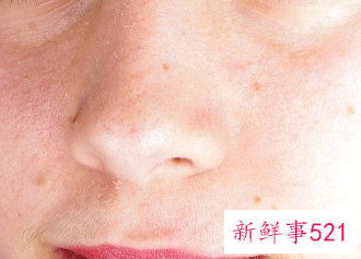 斑点如何淡化的小妙招