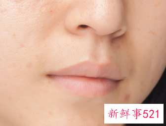 怎么清除鼻子上的黑头