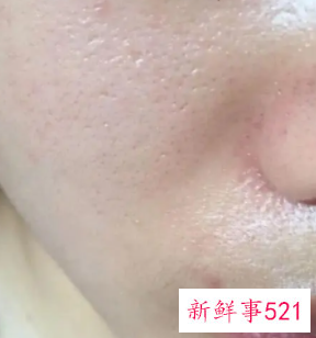 毛孔粗大堵塞黑头怎么治疗