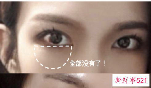 如何去除眼袋最有效