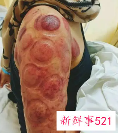 肩膀手臂拔罐都是黑的