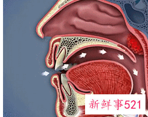 用嘴呼吸会变丑