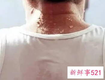 出汗有尿素味是怎么回事