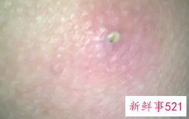 屁股上长硬疙瘩特别疼