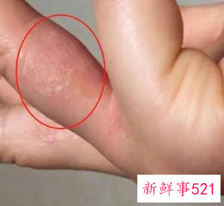 手指痒是怎么回事
