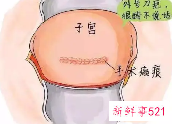 顺产时子宫破裂怎么办