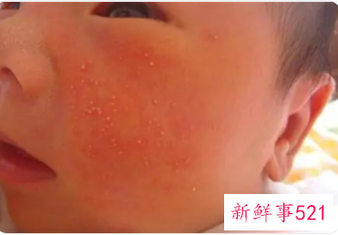 宝宝湿疹怎么处理