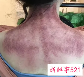 肩膀手臂拔罐都是黑的