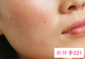 脸上起皮还痒还红怎么办