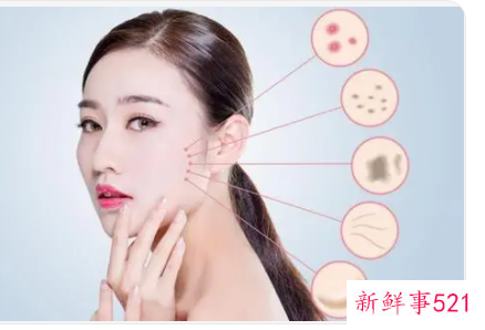 适合学生的祛痘办法