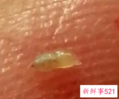 螨虫和痘痘的区别