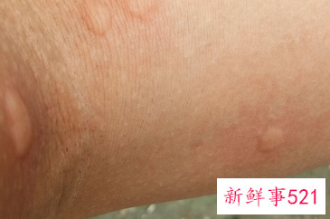 被虫子叮咬后红肿如何处理