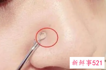 正确清理鼻子上的黑头螨虫