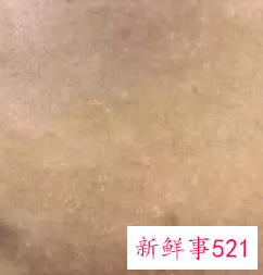 脸上起皮干燥紧绷刺痛怎么办