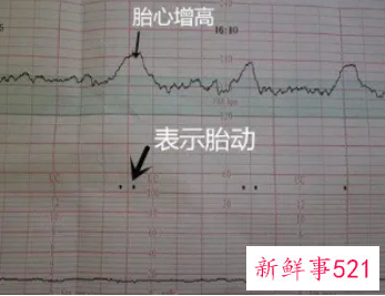 胎心监护图怎么看宫缩