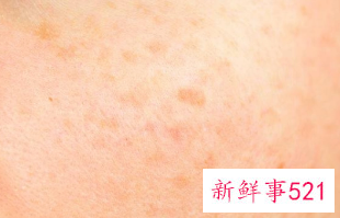 女性脸干燥怎么调理