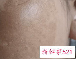 怎么去黑斑呢
