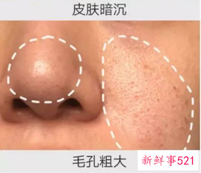 皮肤干燥暗沉毛孔粗大怎么办