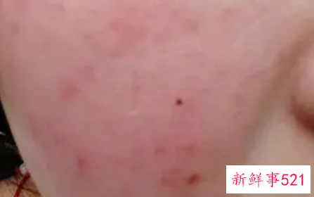 有红血丝就是敏感肌吗