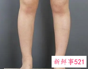 小腿越来越粗怎么改善