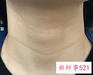 怎样可以改善颈纹