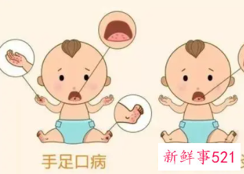 手足口病的传播途径发热特点