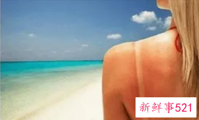 晒伤后可以恢复肤色吗