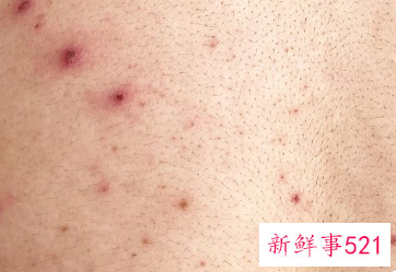 脸起很多小米粒