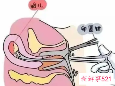 做无痛人流需要准备些什么东西