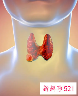 甲状腺早期10个征兆