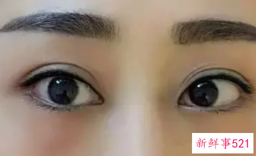 纹美瞳线的术后注意事项