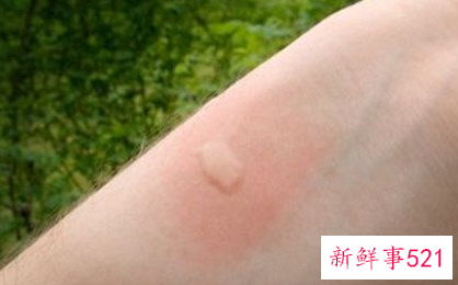 螨虫叮咬后的症状图