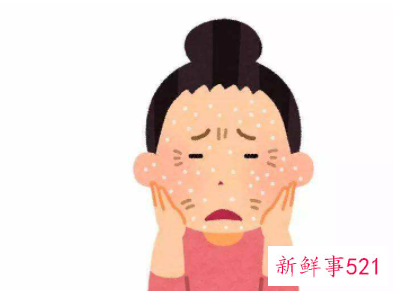 脸干燥紧绷刺痛怎么办