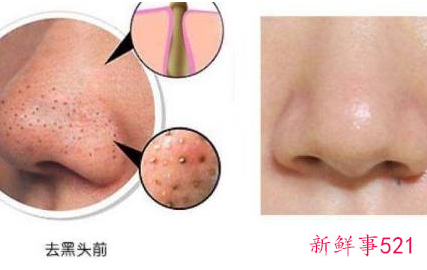 正确清理鼻子上的黑头螨虫