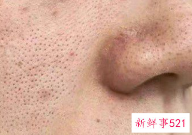 脸上有螨虫去除