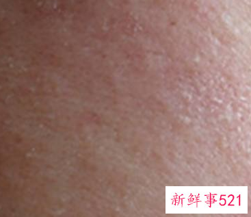 孕早期皮肤干燥脱皮