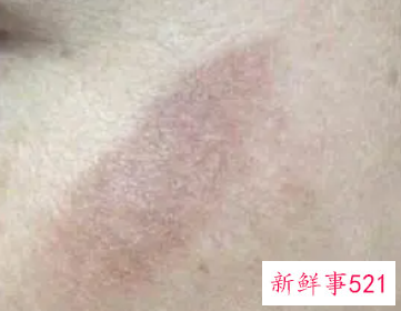 色素沉着会自愈吗