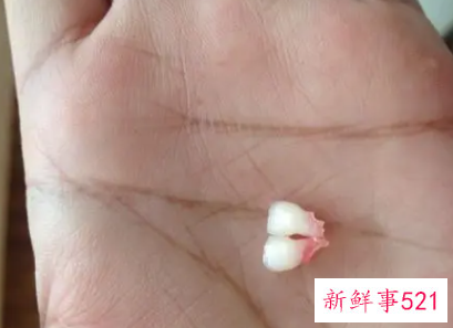 梦见牙齿全部掉了牙齿吐出一把