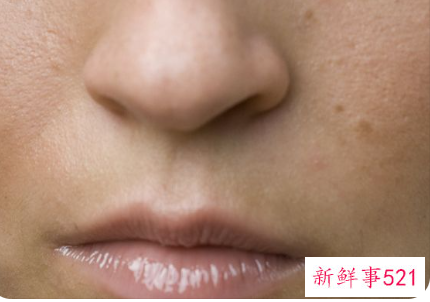 顽固的痘印用什么去除