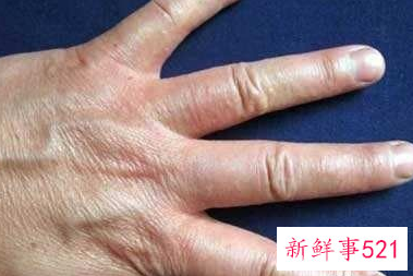 蜕皮现象是什么